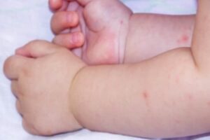 Bệnh tay chân miệng cấp độ 1