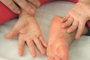 Biểu hiện của bệnh tay chân miệng