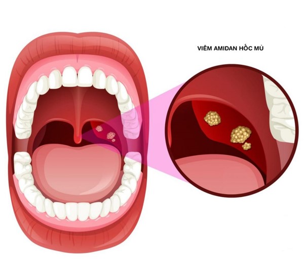 Dấu hiệu viêm amidan được biểu hiện như thế nào?