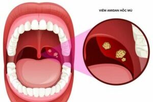 Dấu hiệu viêm amidan được biểu hiện như thế nào?