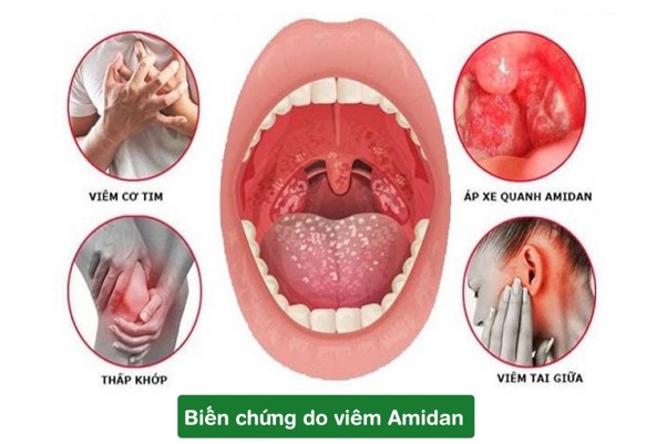 Các biến chứng do amidan gây nên