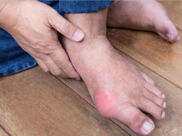 Bệnh gout xảy ra nhiều ở người lớn