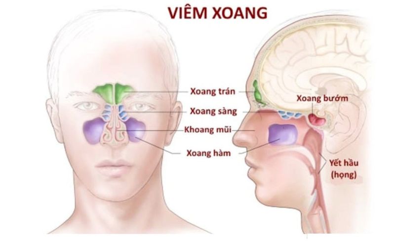 Nguyên nhân gây viêm xoang sàng