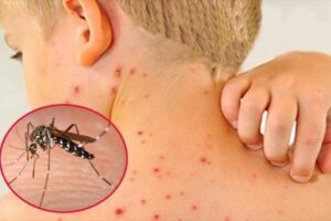 Những triệu chứng khi bị sốt xuất huyết