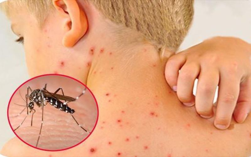 Những triệu chứng khi bị sốt xuất huyết