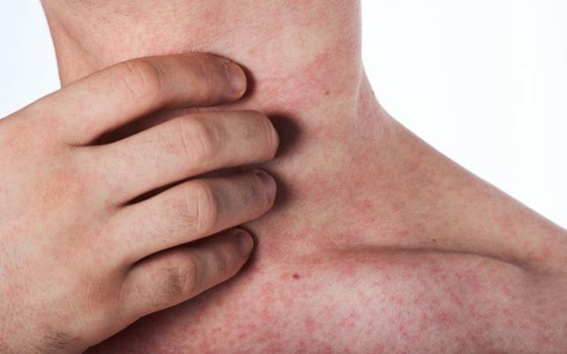 Sốt xuất huyết ở người lớn là gì?