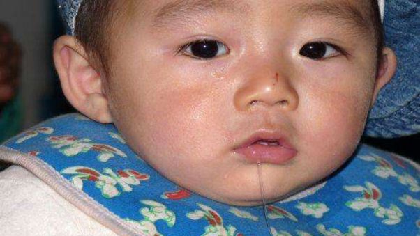 Thông tin chung về bệnh tay chân miệng cấp độ 1