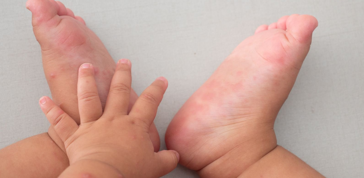 bé sốt tay chân lạnh