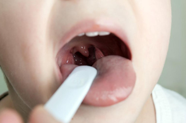 Các triệu chứng cơ bản của viêm họng cấp