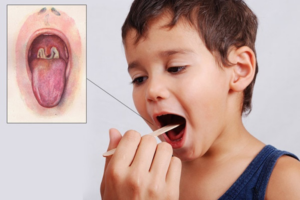 Viêm họng cấp là gì
