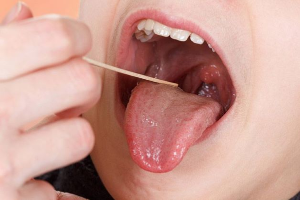 Viêm họng cấp là gì?