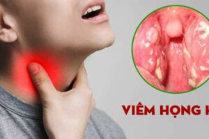 Viêm họng hạt là gì?