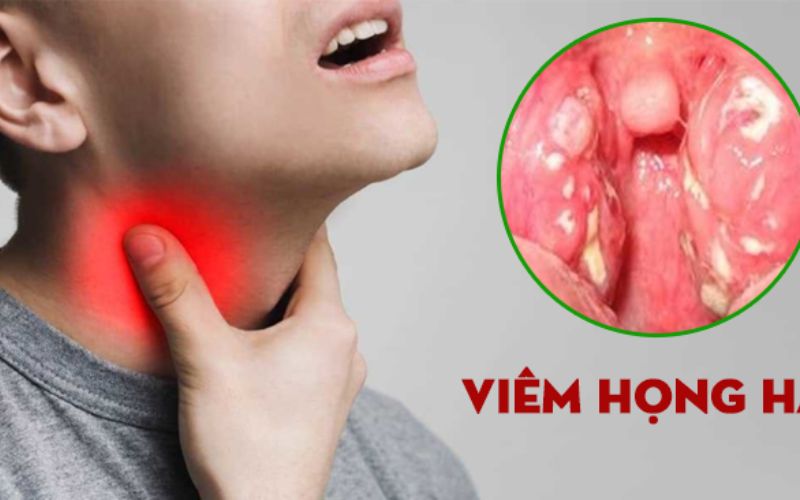Viêm họng hạt là gì?