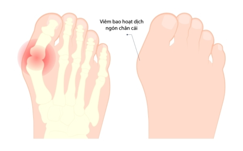 Viêm bao hoạt dịch khớp khiến trẻ bị đau nhói ở lòng bàn chân