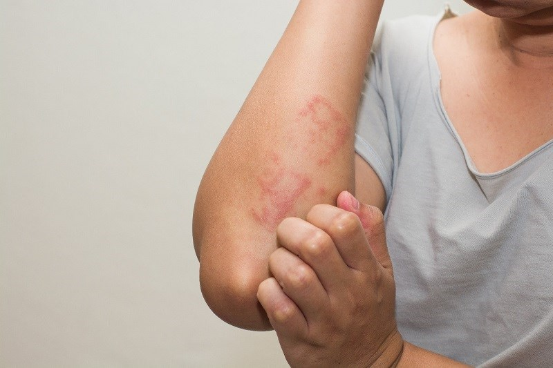 Dị ứng thực phẩm có thể gây tiêu chảy, nổi mẩn, khó thở và giảm huyết áp.