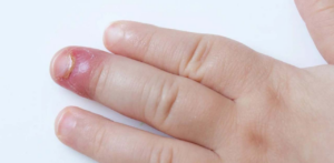 Đau đầu ngón tay là bệnh gì?