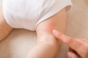 Côn trùng cắn cũng là nguyên nhân gây ửng đỏ