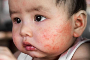 Trẻ bị chàm nên xuất hiện các nốt ửng đỏ