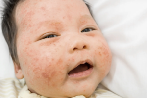 Mụn hạt kê ảnh hưởng đến sinh hoạt của bé
