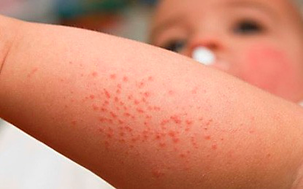 Sốt xuất huyết khi nào khỏi?