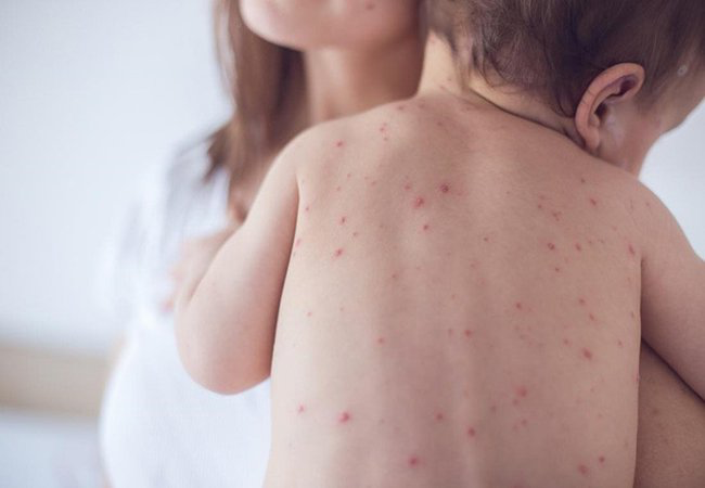 Biểu hiện của sốt phát ban