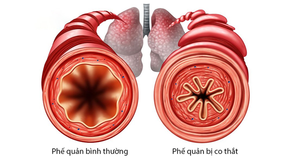 Bệnh viêm phế quản co thắt có thể xuất phát từ nhiều nguyên nhân khác nhau