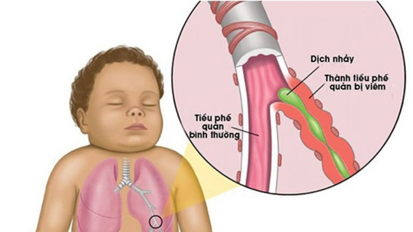 Trẻ em thường mắc bệnh viêm tiểu phế quản, nhất là từ 2 đến 6 tháng tuổi