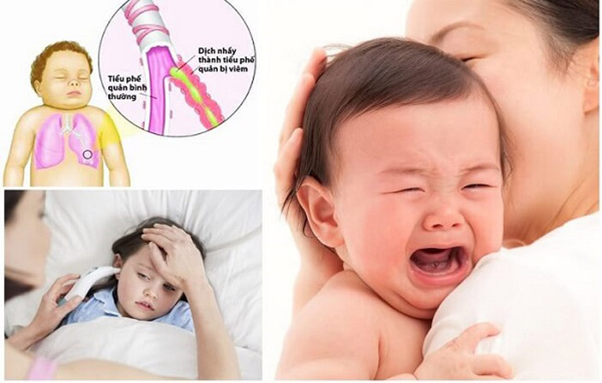 Biểu hiện bệnh viêm tiểu phế quản thường là sốt, ho, lồng ngực rút lõm khi thở